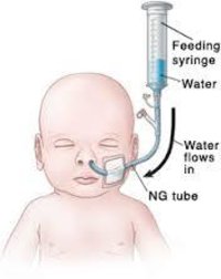 infant-feeding-tube