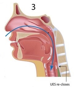 esophageal phase 3