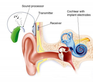 Cochlear implant electronic device