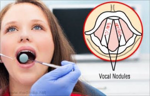 vocal Nodules