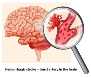 Hemorrhage stroke