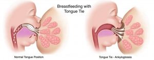tongue-tie on breast feeding