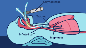 Endotracheal Tube